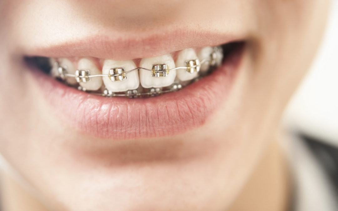 What Age Do Kids Get Braces? How to Tell If Your Child Needs Braces
