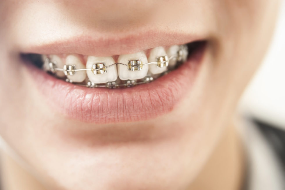 What Age Do Kids Get Braces? How to Tell If Your Child Needs Braces