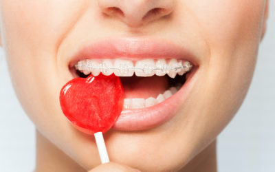 Everything You Need to Know About Invisalign