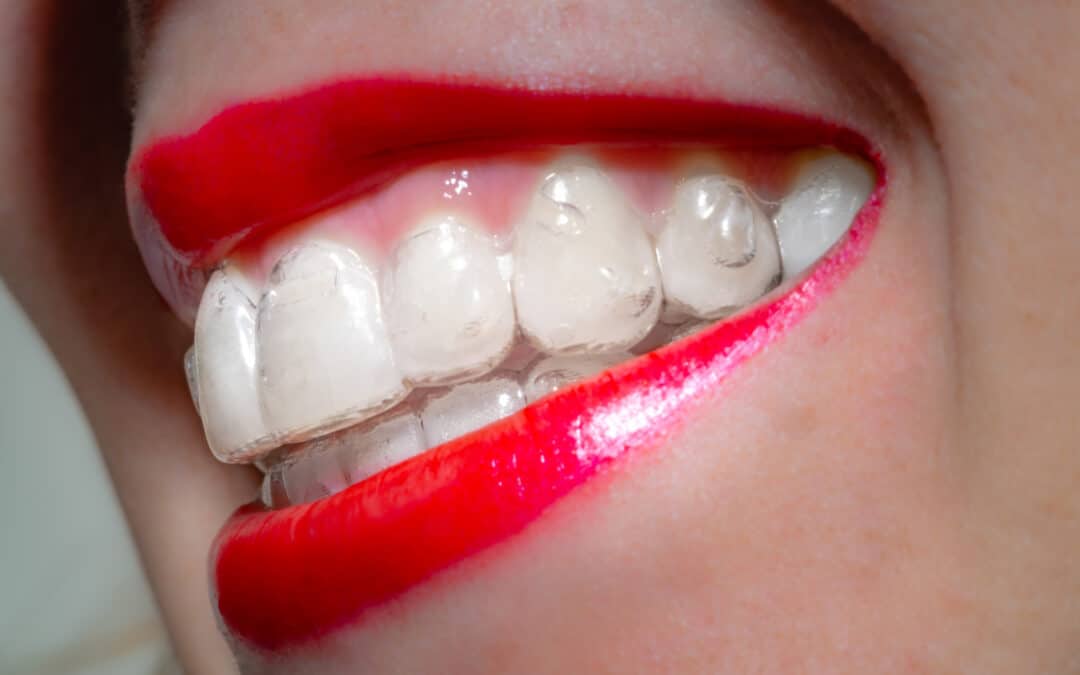 6 Benefits of Adult Invisalign for Achieving the Perfect Smile