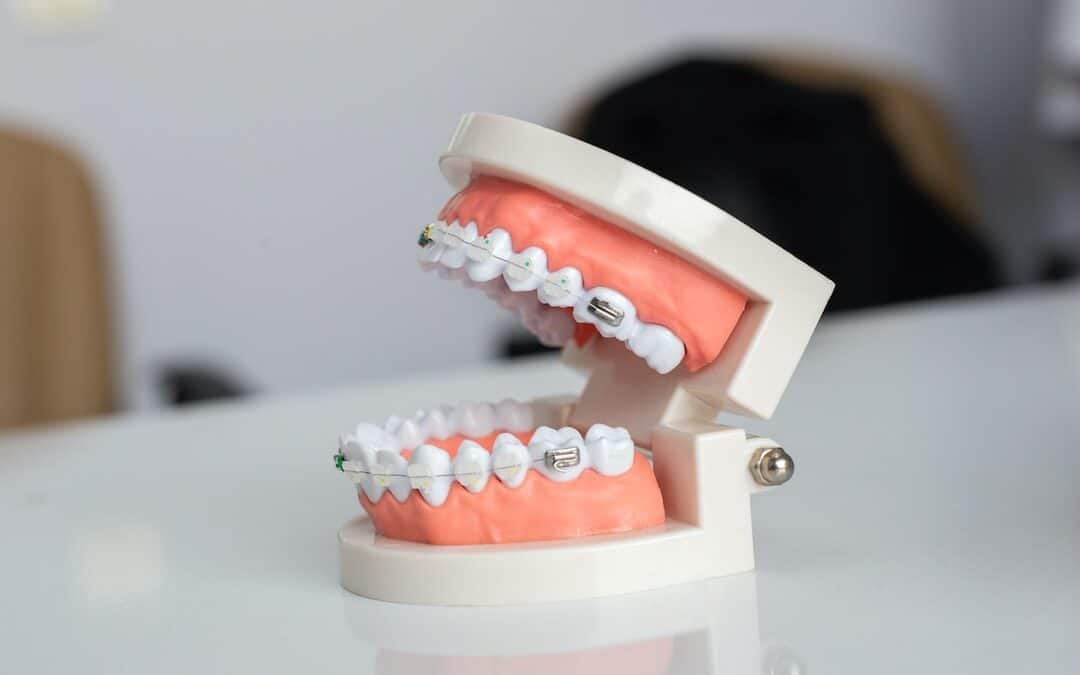 Braces on Crooked Teeth: How Correction Works