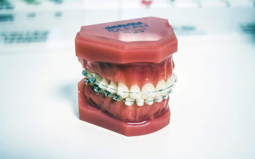 Do Ceramic Braces Stain? Find Out How to Avoid Discoloration