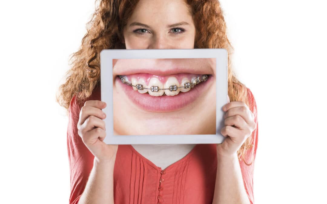 Braces Timeline: How Long Will Your Perfect Smile Take?