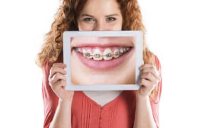 Braces Timeline: How Long Will Your Perfect Smile Take?